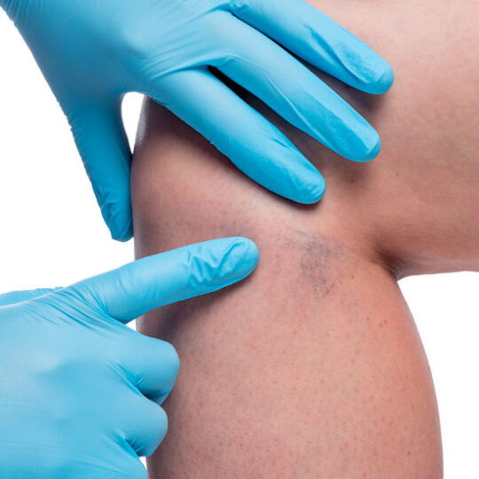 Chirurgia Ambulatoriale delle Varici Cliniche Bosso & Indolfi