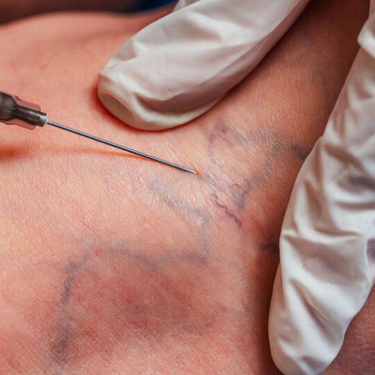 Scleroterapia Cliniche Bosso e Indolfi